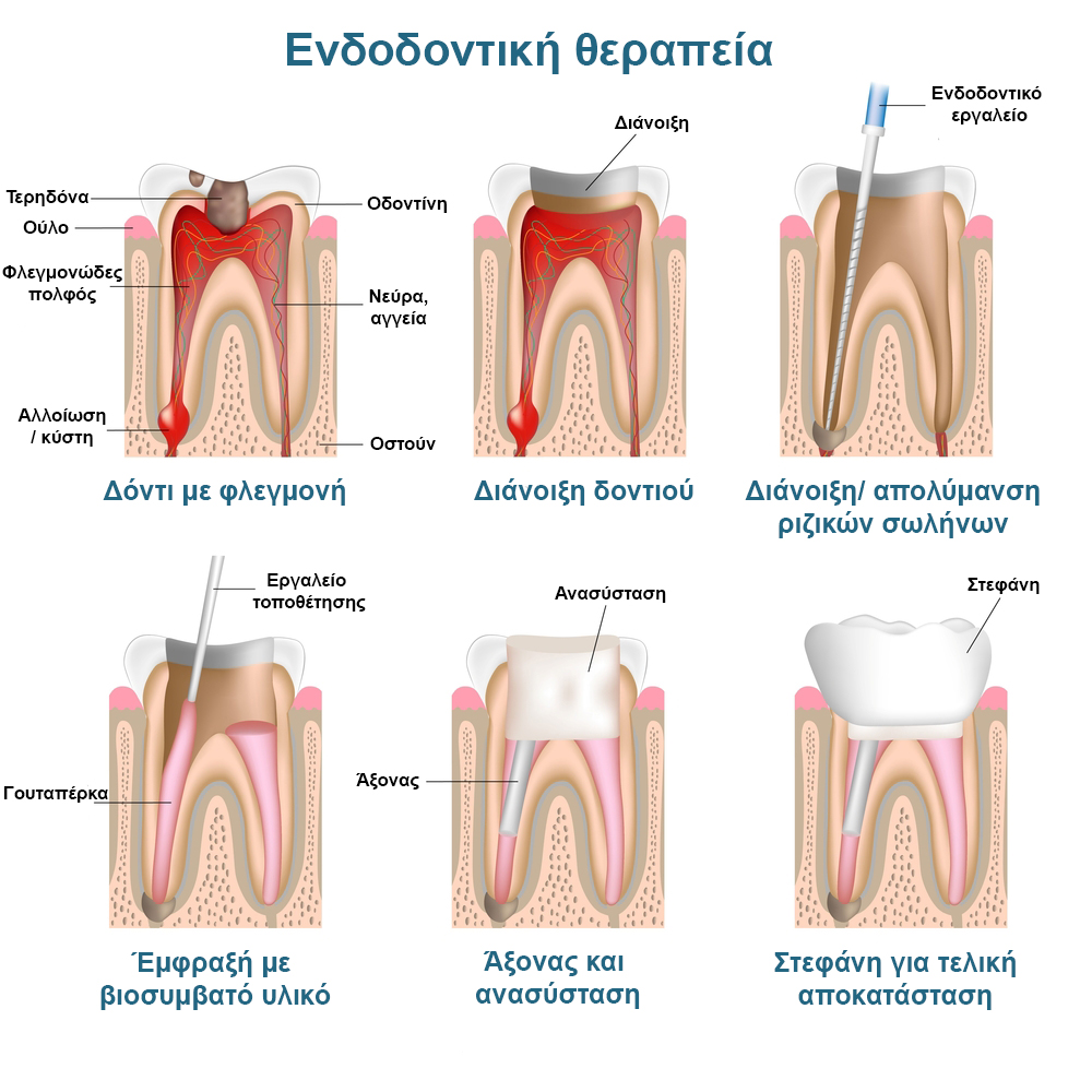 Endodontic_pic_greek